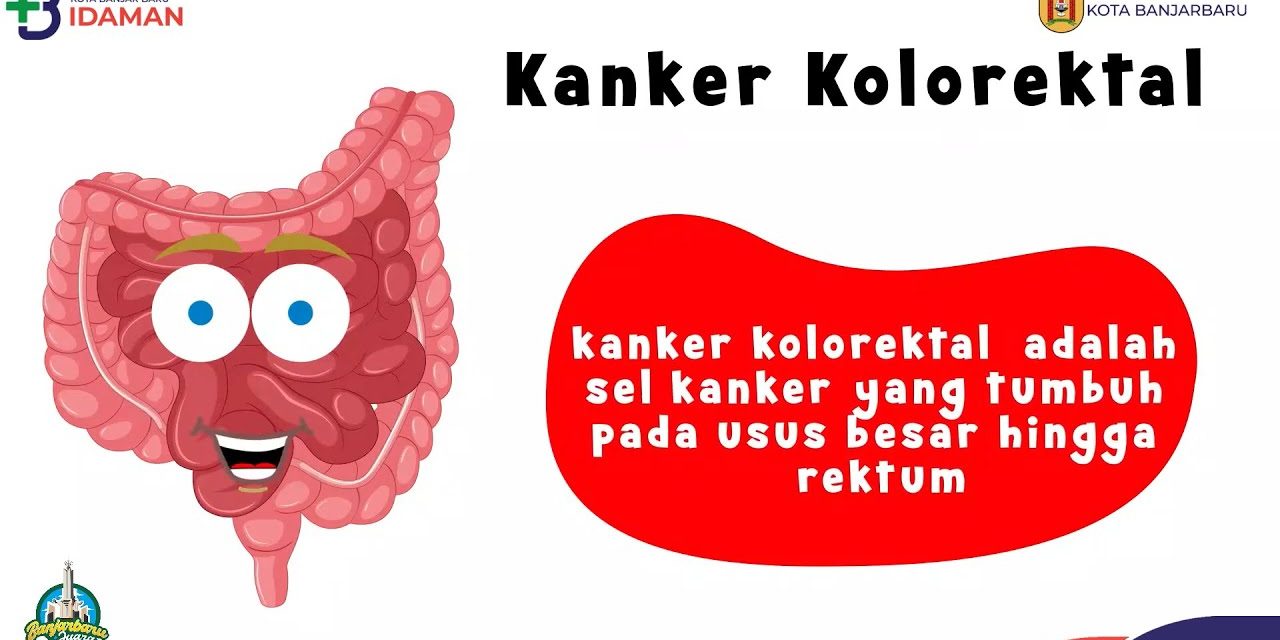 Dokter Ingatkan: 90 Persen Kasus Kanker Kolorektal Terlambat