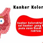 Dokter Ingatkan: 90 Persen Kasus Kanker Kolorektal Terlambat